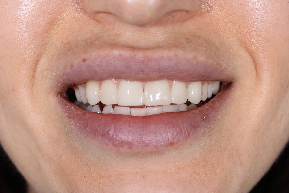 Реставрация зубов. Идеально ровный режущий край